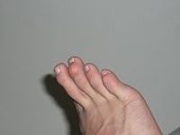 Hammertoe